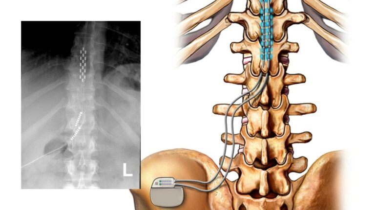 Сочетание стимуляции спинного мозга и виртуальной реальности помогает бороться с хроническими болями