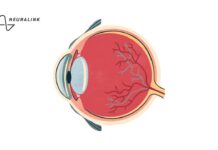 Имплант компьютерного зрения Blindsight от Neuralink должен подарить зрение слепым