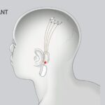Neuralink получила разрешение на испытания на людях